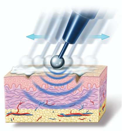 Fibrinaufbau und Straffung durch Radiofrequenz