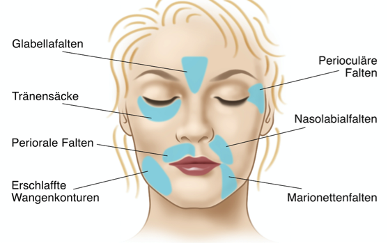 Monopolare Radiofrequenz